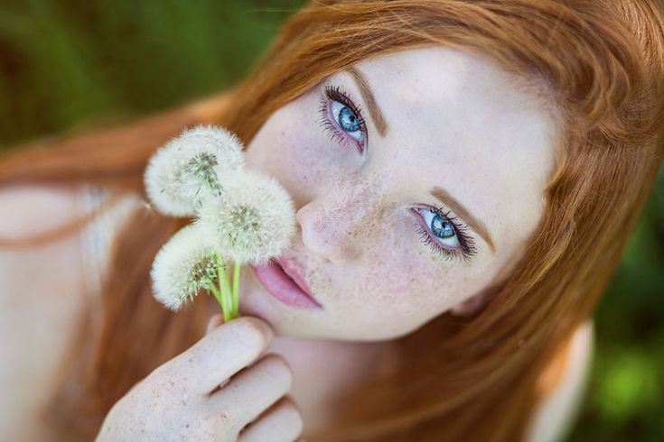 Freckles Can Indicate Sun Sensitivity