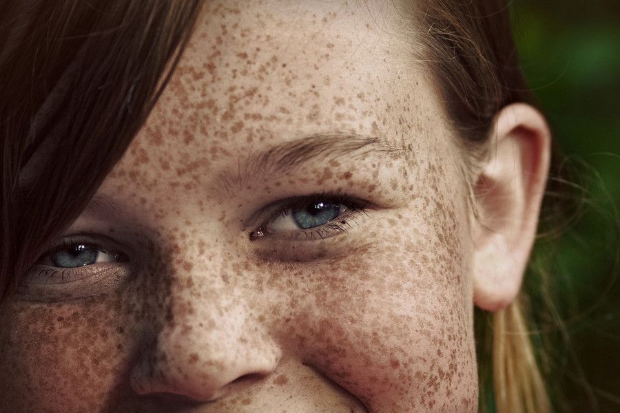 What Causes Freckles