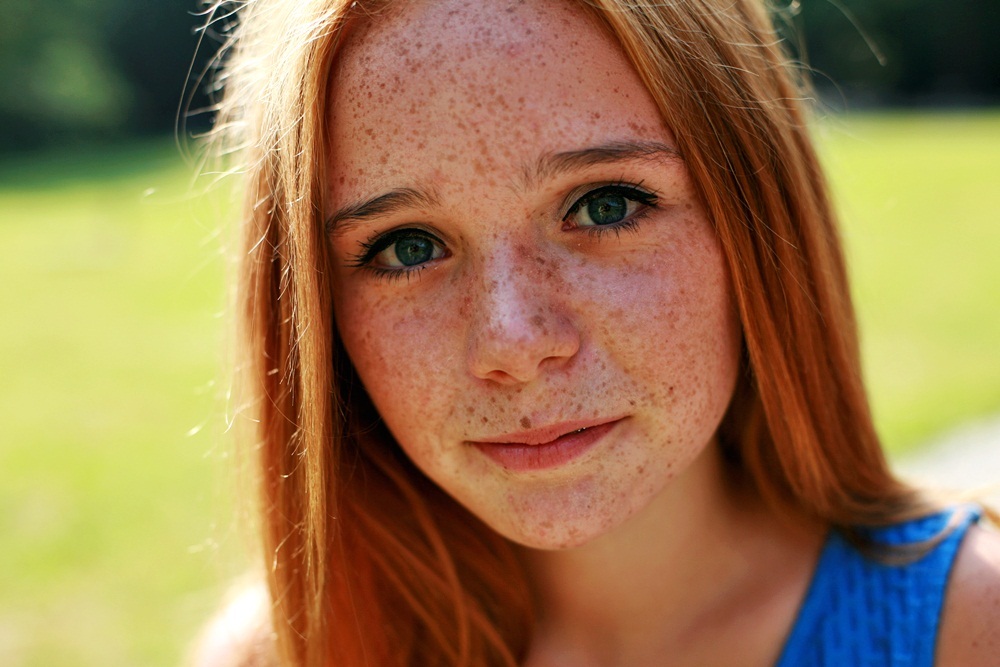 What Causes Freckles