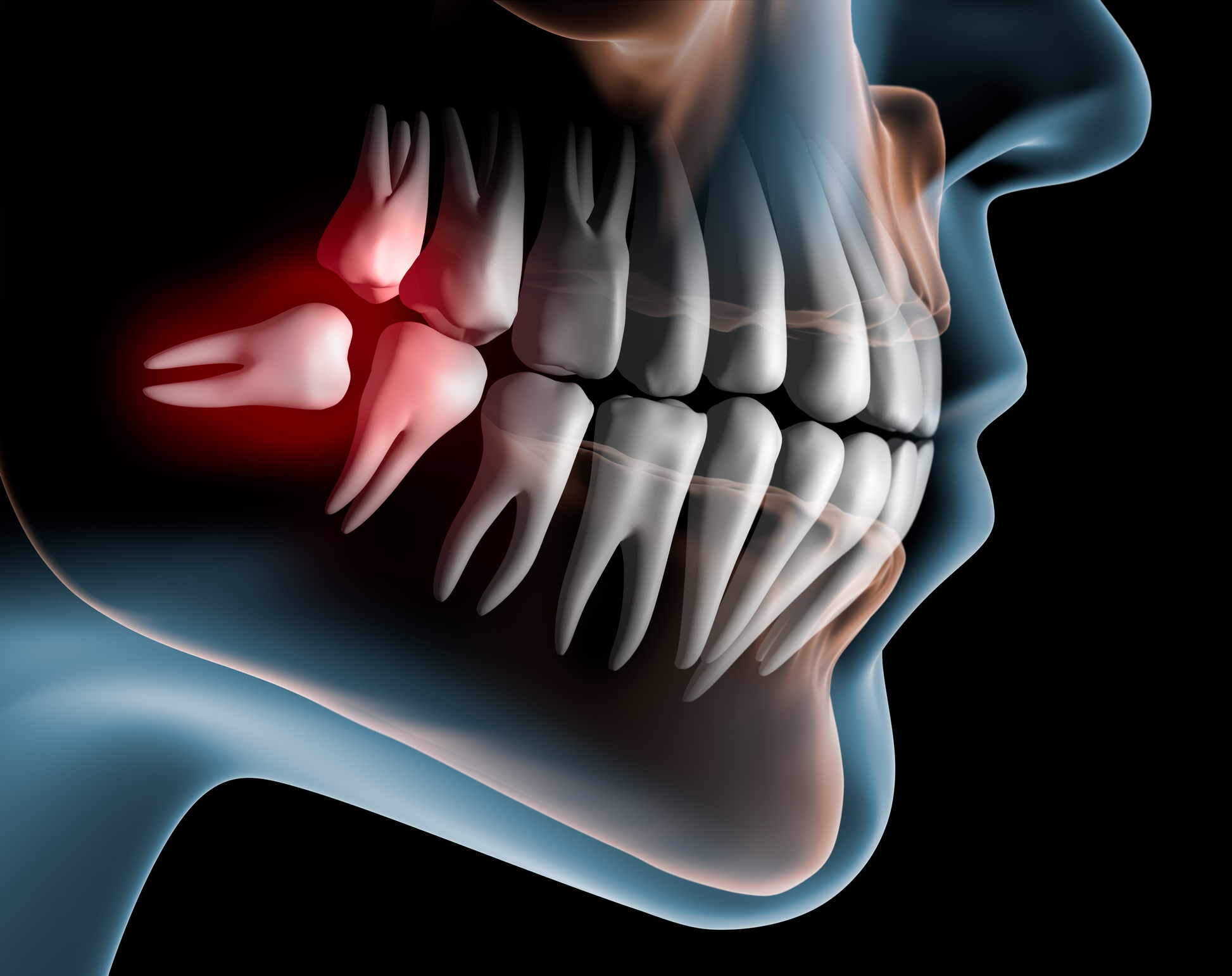 Wisdom tooth